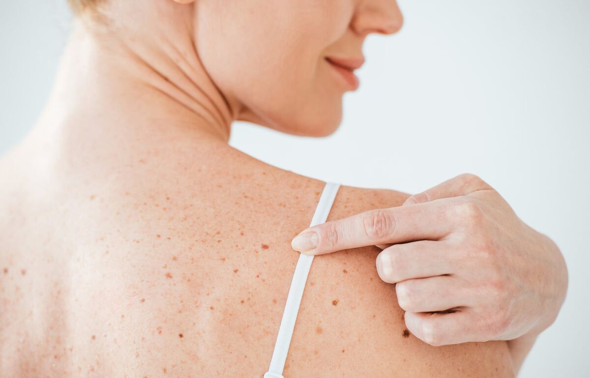 Zur Hautkrebs-Vorsorge gehört auch die Muttermal-Selbstkontrolle. Akupunktur lindert Schmerzen/ Bild: Fotolia Im Rahmen der Früherkennung ist es wichtig, immer wieder selbst ein Auge auf seinen Muttermalen zu haben